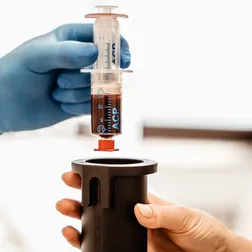 Eine Kanüle mit Eigenblut wird zur Plasma-Plättchen Gewinnung im ACP Gerät vorbereitet