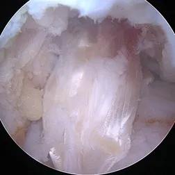 Athros­kopische Aufnahme einer Kreuzbandverletzung im Knie während eine minimal-invasiven Operation