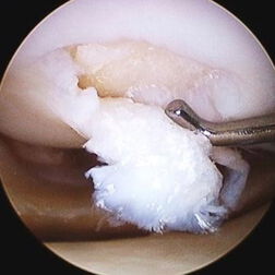 Athros­kopische Aufnahme einer Knorpeltransplantation bei einer minimal-invasiven Operation