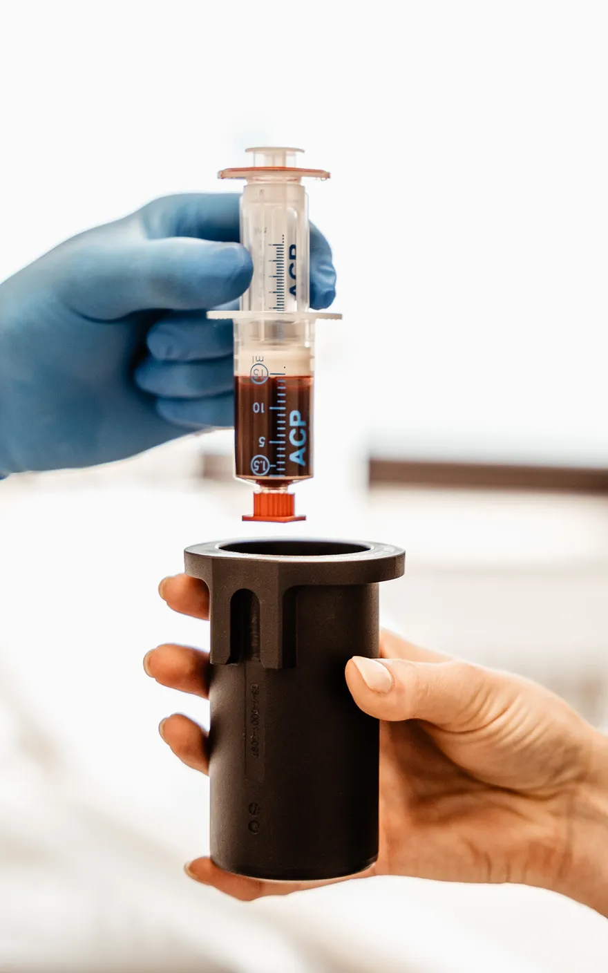 Eine Kanüle mit Eigenblut wird zur Plasma-Plättchen Gewinnung im ACP Gerät vorbereitet