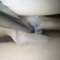 Athros­kopische Aufnahme des Miniskus bei einer minimal-invasiven Operation